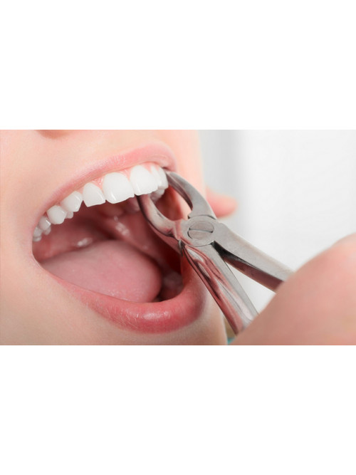  Удаление постоянного зуба 