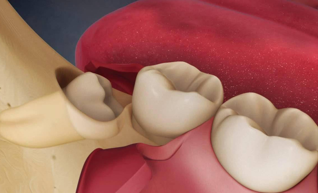 Что это такое аутотрансплантация зубов?
